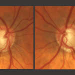 grading and evaluating the optic nerve